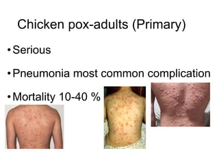 Chicken pox-adults (Primary)
•Serious
•Pneumonia most common complication
•Mortality 10-40 %
 