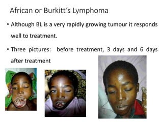 African or Burkitt’s Lymphoma
• Although BL is a very rapidly growing tumour it responds
well to treatment.
• Three pictures: before treatment, 3 days and 6 days
after treatment
 