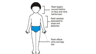 Messles Rash Distribution Epidemiology of measles and its prevention.pptx