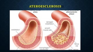 ATEROESCLEROSIS
 