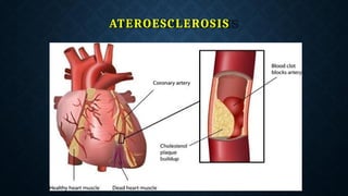 ATEROESCLEROSIS
 