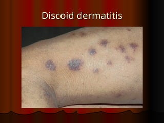 Dist Skin 3.ECZEMA skin diseases presentations.ppt