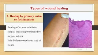 Approximated Incision Healing Ridge 3. Healing, regenaration of repair of sound healing | PPTX
