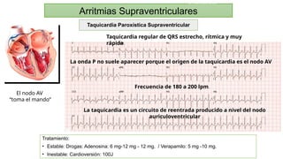 Cardioversion 100j Arritmias Más Frecuentes en Emergencia: Diagnóstico y Tratamiento ...