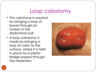 Comprehensive Guide to Colostomy: Indications, Types, Care, and Closure ...