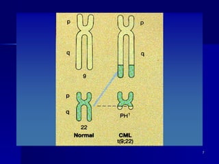 Comprehensive Overview of Chronic Myeloid Leukemia: Diagnosis ...
