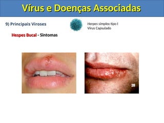 Vírus e Doenças Associadas
Vírus e Doenças Associadas
9) Principais Viroses
Hespes Bucal
Hespes Bucal - Sintomas
- Sintomas
Herpes simplex tipo I
Vírus Capsulado
 