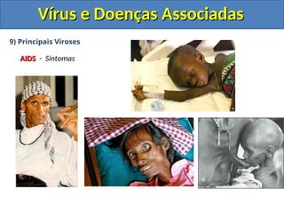 Vírus e Doenças Associadas
Vírus e Doenças Associadas
9) Principais Viroses
AIDS
AIDS - Sintomas
 
