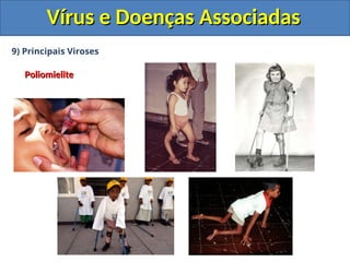 Vírus e Doenças Associadas
Vírus e Doenças Associadas
9) Principais Viroses
Poliomielite
Poliomielite
 