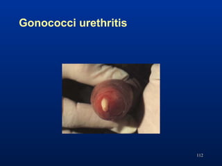 Gonococci urethritis
112
 