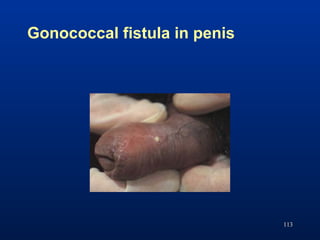 Gonococcal fistula in penis
113
 