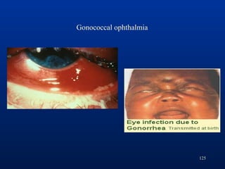 125
Gonococcal ophthalmia
 