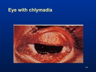 Eye with chlymadia
148
 
