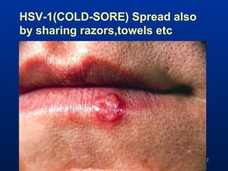 182
HSV-1(COLD-SORE) Spread also
by sharing razors,towels etc
 