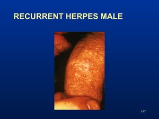 RECURRENT HERPES MALE
187
 