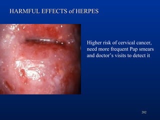 202
Higher risk of cervical cancer,
need more frequent Pap smears
and doctor’s visits to detect it
HARMFUL EFFECTS of HERP...