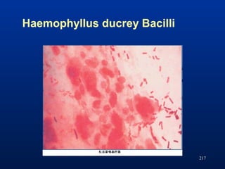 Haemophyllus ducrey Bacilli
217
 