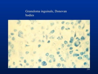 238
Granuloma inguinale, Donovan
bodies
 