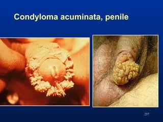 Condyloma acuminata, penile
257
 