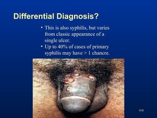 Differential Diagnosis?
418
• This is also syphilis, but varies
from classic appearance of a
single ulcer.
• Up to 40% of ...