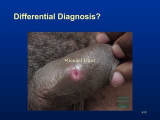 Differential Diagnosis?
419
•Genital Ulcer
 