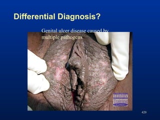 Differential Diagnosis?
420
Genital ulcer disease caused by
multiple pathogens
 