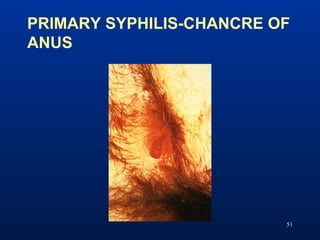 PRIMARY SYPHILIS-CHANCRE OF
ANUS
51
 