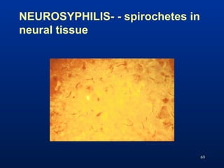 NEUROSYPHILIS- - spirochetes in
neural tissue
69
 