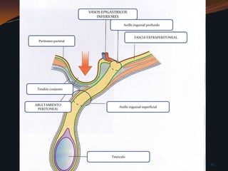 VASOS EPIGASTRICOS INFERIORESAnillo inguinal profundoFASCIA EXTRAPERITONEALPeritoneo parietalTendón conjuntoABULTAMIENTO PERITONEALAnillo inguinal superficial Testículo 23