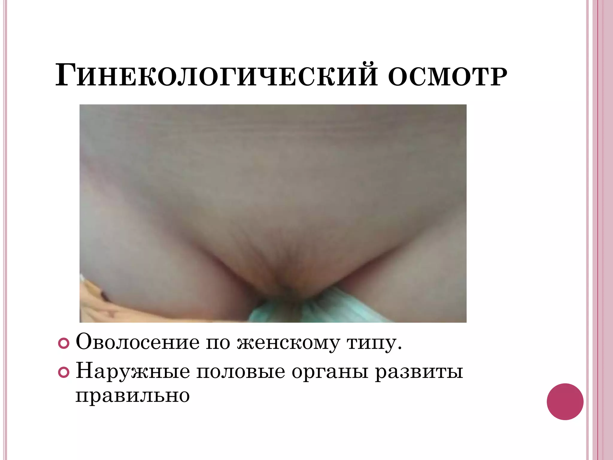 ГИНЕКОЛОГИЧЕСКИЙ ОСМОТР




 Оволосениепо женскому типу.
 Наружные половые органы развиты
  правильно
 