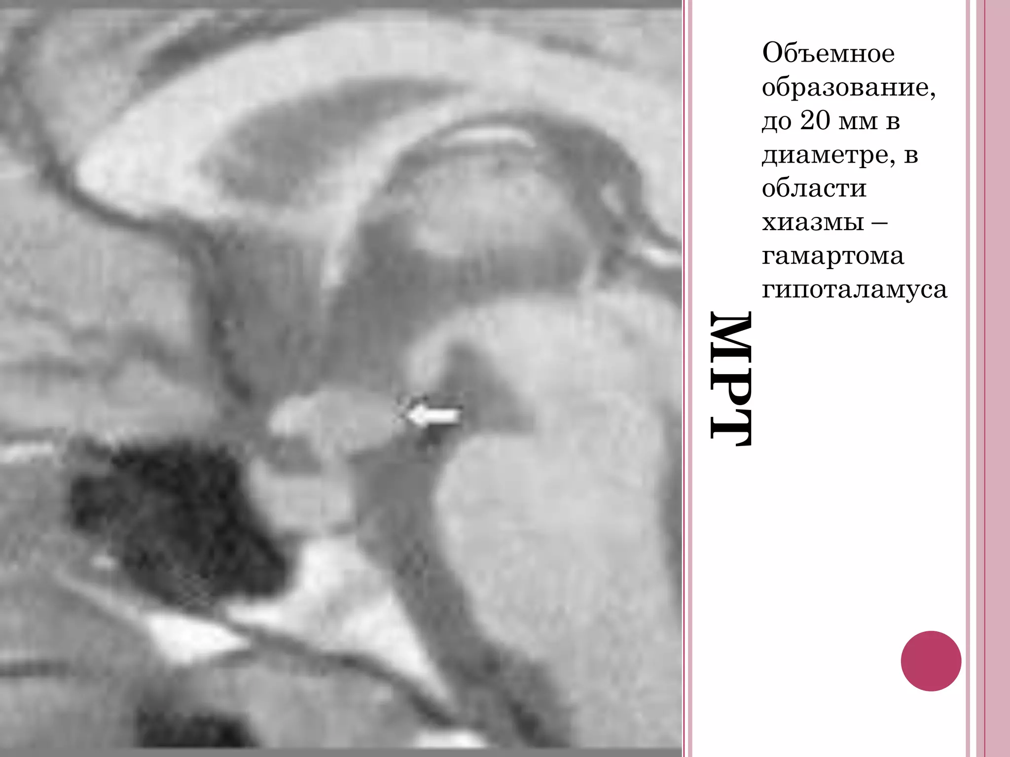 Объемное
  образование,
  до 20 мм в
  диаметре, в
  области
  хиазмы –
  гамартома
  гипоталамуса




МРТ
 