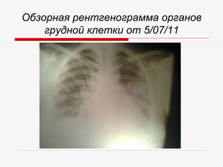 Обзорная рентгенограмма органов
    грудной клетки от 5/07/11
 
