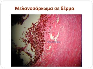 Μελανοσάρκωμα σε δέρμα
 