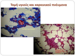 Τομή υγιούς και καρκινικού πνέυμονα
 