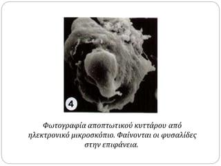 Φωτογραφία αποπτωτικού κυττάρου από
ηλεκτρονικό μικροσκόπιο. Φαίνονται οι φυσαλίδες
στην επιφάνεια.
 