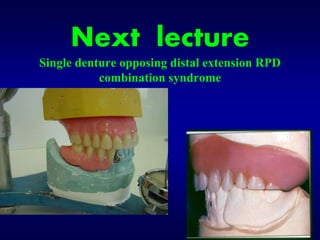 Maxillary Single Tooth Rpd 3 a. management of maxillary and mandibular single complete dentures | PPT