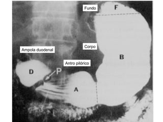 Fundo Corpo Antro pilórico Ampola duodenal 