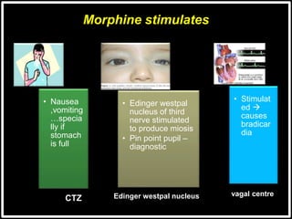 Morphine stimulates
CTZ
• Nausea
,vomiting
…specia
lly if
stomach
is full
Edinger westpal nucleus
• Edinger westpal
nucleus of third
nerve stimulated
to produce miosis
• Pin point pupil –
diagnostic
vagal centre
• Stimulat
ed 
causes
bradicar
dia
 