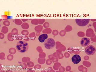 ANEMIA MEGALOBLÁSTICA: SP
 