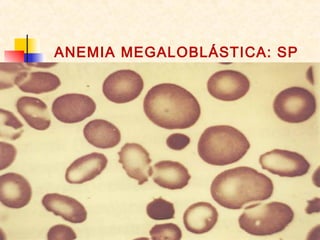 ANEMIA MEGALOBLÁSTICA: SP
 