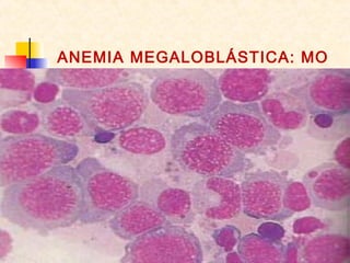 ANEMIA MEGALOBLÁSTICA: MO
 
