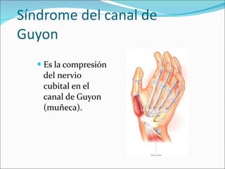 Síndrome del canal de Guyon <ul><li>Es la compresión del nervio cubital en el canal de Guyon (muñeca).  </li></ul>