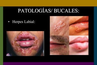 PATOLOGÍAS/ BUCALES:
• Herpes Labial:
 
