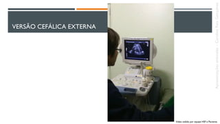 VERSÃO CEFÁLICA EXTERNA
Video cedido por equipe HSF e Paciente.
Apresentaçõesanômalas–CarolineReisGonçalves
 