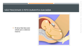 NÃO TRACIONAR O FETO DURANTE A SUA SAÍDA
 O dorso fetal deve estar
voltado para o abdomen
materno
Apresentaçõesanômalas–CarolineReisGonçalves
 