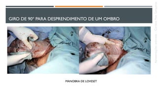 GIRO DE 90º PARA DESPRENDIMENTO DE UM OMBRO
MANOBRA DE LOVESET
Apresentaçõesanômalas–CarolineReisGonçalves
 