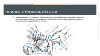 MANOBRA DE MAURICEAU-SMELIE-VEIT
Apresentaçõesanômalas–CarolineReisGonçalves
 