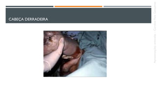 CABEÇA DERRADEIRA
Apresentaçõesanômalas–CarolineReisGonçalves
 