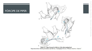 FÓRCIPE DE PIPER
Apresentaçõesanômalas–CarolineReisGonçalves
 