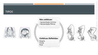 TIPOS
Não cefálicas:
• Apresentação Córmica
• Apresentação Pélvica
Cefálicas Defletidas:
Bregma
Fronte
Face
Apresentaçõesanômalas–CarolineReisGonçalves
 